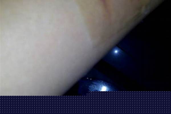 刀疤怎么样才好的快点